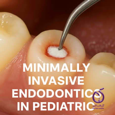 Understanding MID: How It Relates to Pulpotomy and Pulp Capping