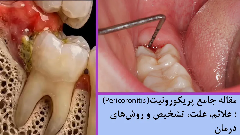 پریکورونیت یا فلپ لثه چیست؟ علائم، علت، تشخیص و درمان التهاب اطراف دندان عقل