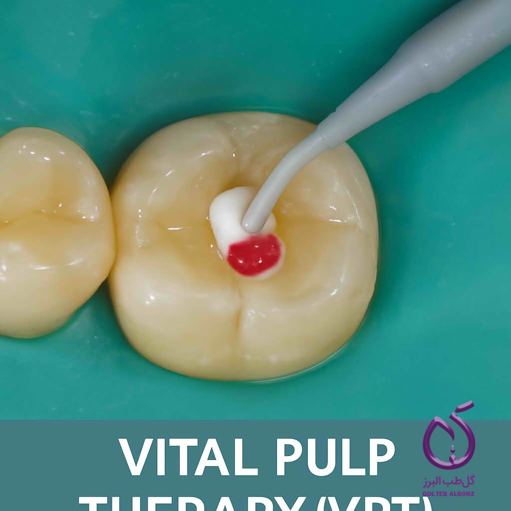 تفاوت پالپ کپینگ با Minimally invasive dentisrty