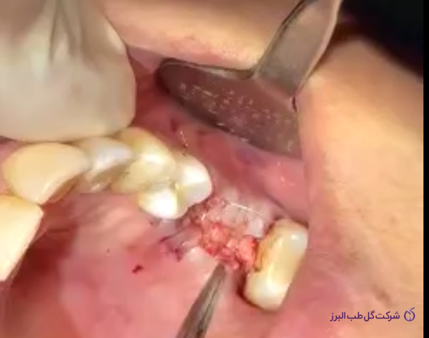 نحوه استفاده از چسب اوراید در محل ساکت دندان بیمار