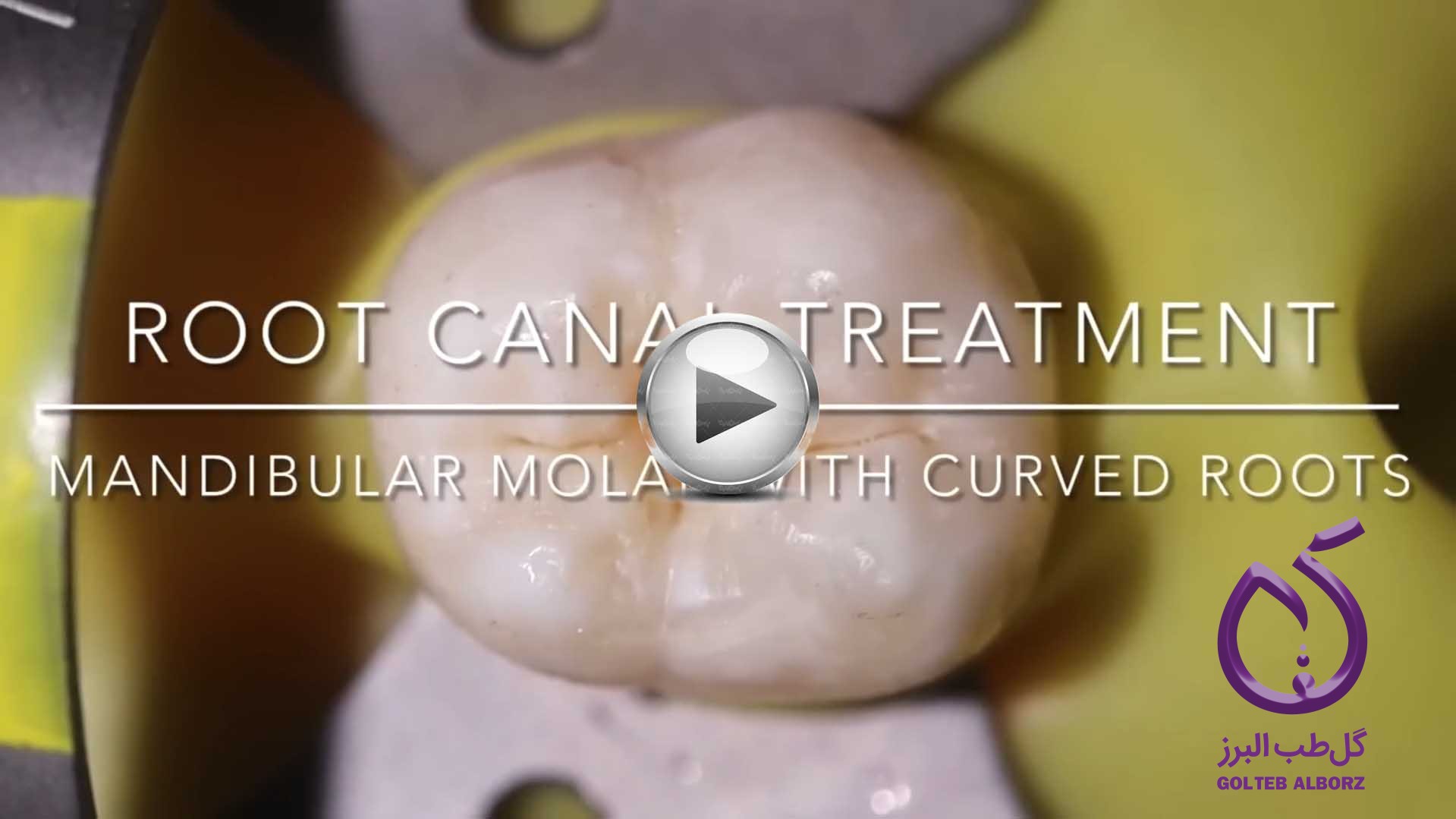Video demonstration of endodontic treatment in a mandibular molar with multiple canals and curved roots
