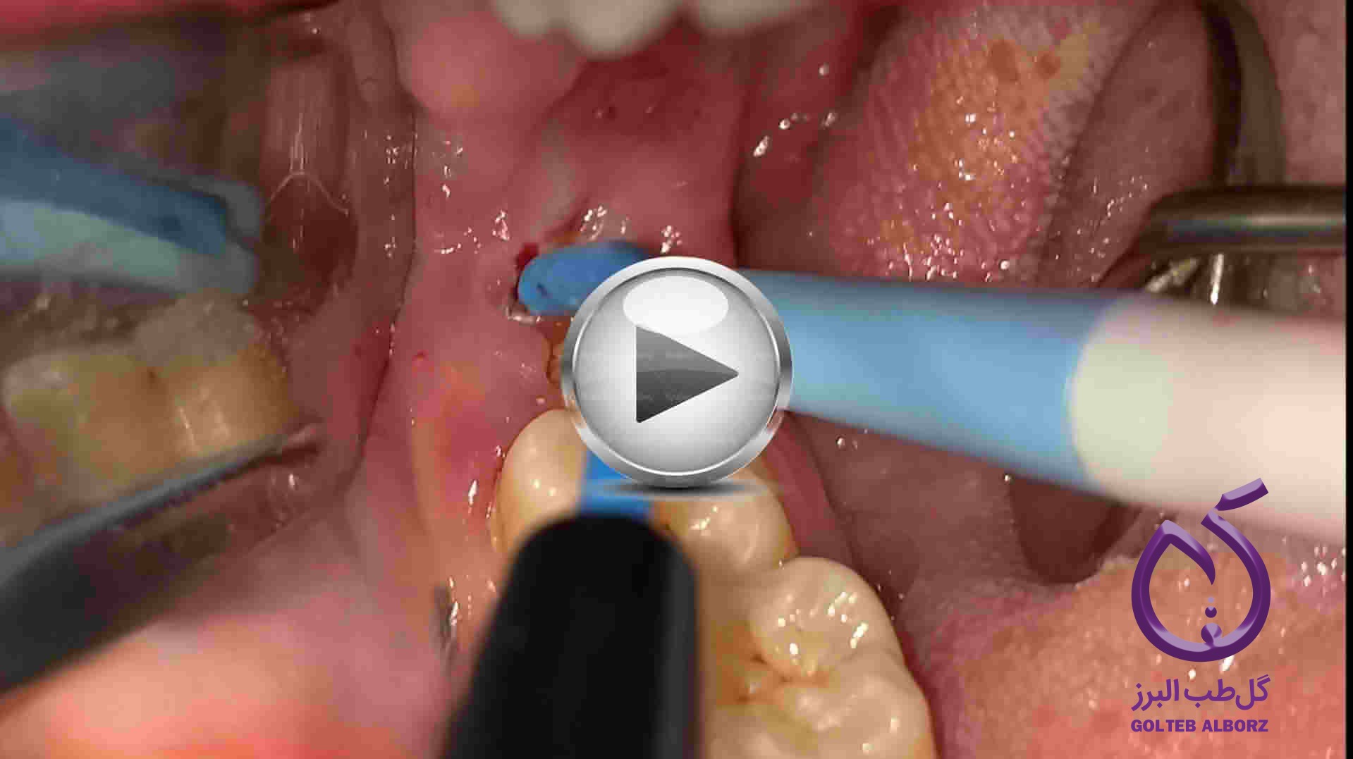 video-of-wisdom-tooth-extraction-in-the-upper-and-lower-jaw