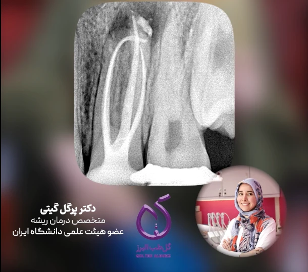 🦷🎥 ویدئوی آموزشی | فلسفه اصلی تکنیک Warm Vertical Condensation از زبان دکتر پرگل گیتی