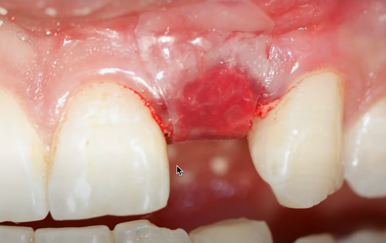 Goltebdental_Ora-Aid_Intraoral